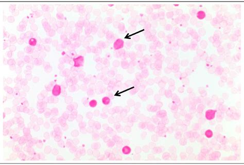 kleihauer test blood bottle|false positive kleihauer betke.